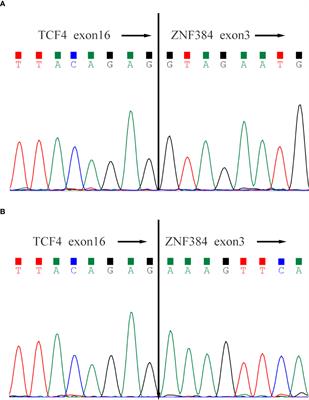 Whole transcriptome sequencing reveals a TCF4-ZNF384 fusion in acute lymphoblastic leukemia